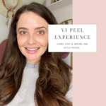 VI Peel Experience with Before and After Photos